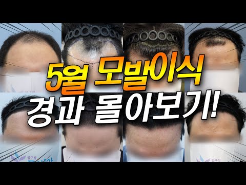 [Mobien TV] 책임지고 만들어냈습니다! 5월 경과 모음집 #광주탈모치료 #전남모발이식