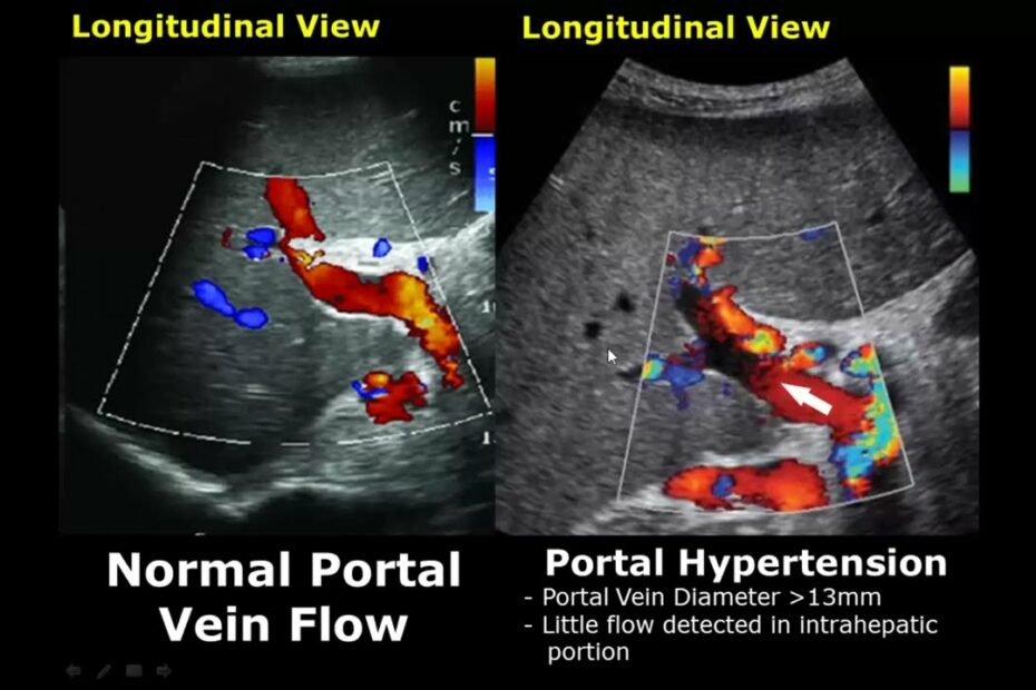 Liver Ultrasound Normal Vs Abnormal Image Appearances Comparison | Liver  Pathologies Usg - Youtube