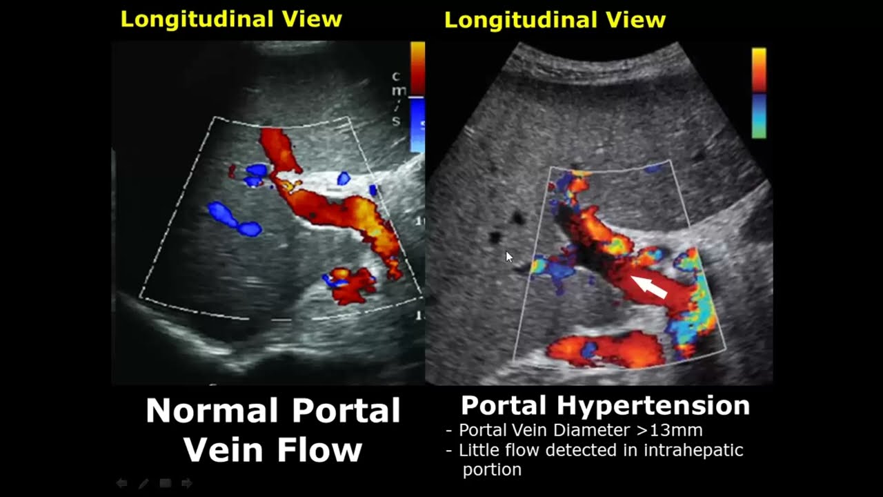 Liver Ultrasound Normal Vs Abnormal Image Appearances Comparison | Liver  Pathologies Usg - Youtube