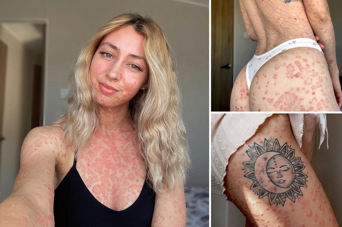 I Have Severe Psoriasis — It Took Me Years To Wear A Bikini
