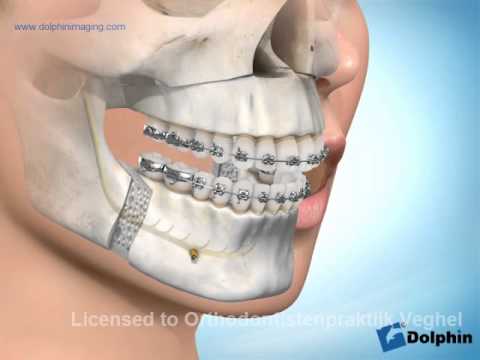 Chirurgische kaakcorrectie (onder- en bovenkaak)