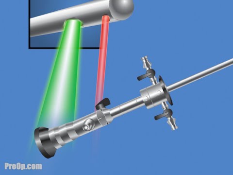 Laser Vaporization of the Prostate