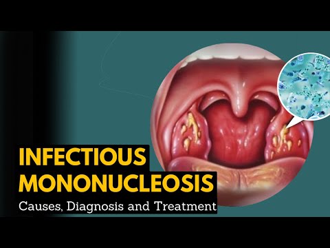 Infectious mononucleosis, Causes, Signs and Symptoms, Diagnosis and Treatment.