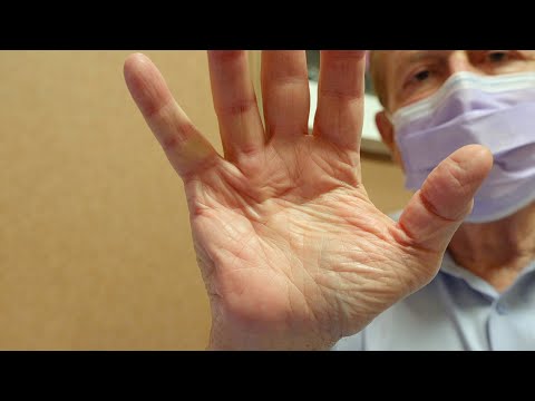 Mayo Clinic Minute - Treating Dupuytren’s contracture without surgery