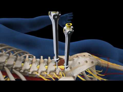 Lumbar Fusion of L5 S1 Animation